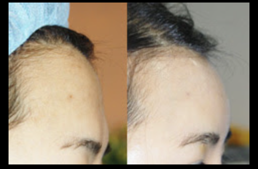 Cost and Before & After of Forehead Augmentation Surgery in Korea