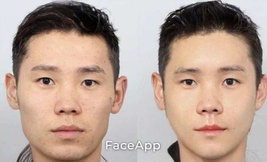 Zygoma Augmentation Surgery in Korea: Enhance Your Facial Contours